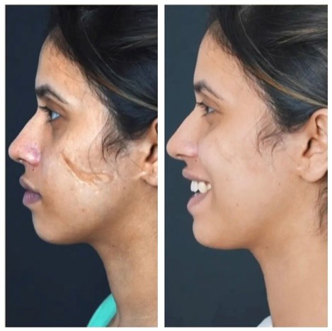 Age Zero™️ Exosomes Before After Photo Improved Skin Texture