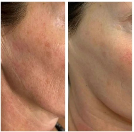 Age Zero™️ Exosomes Before After Photo Improved Skin Pigment