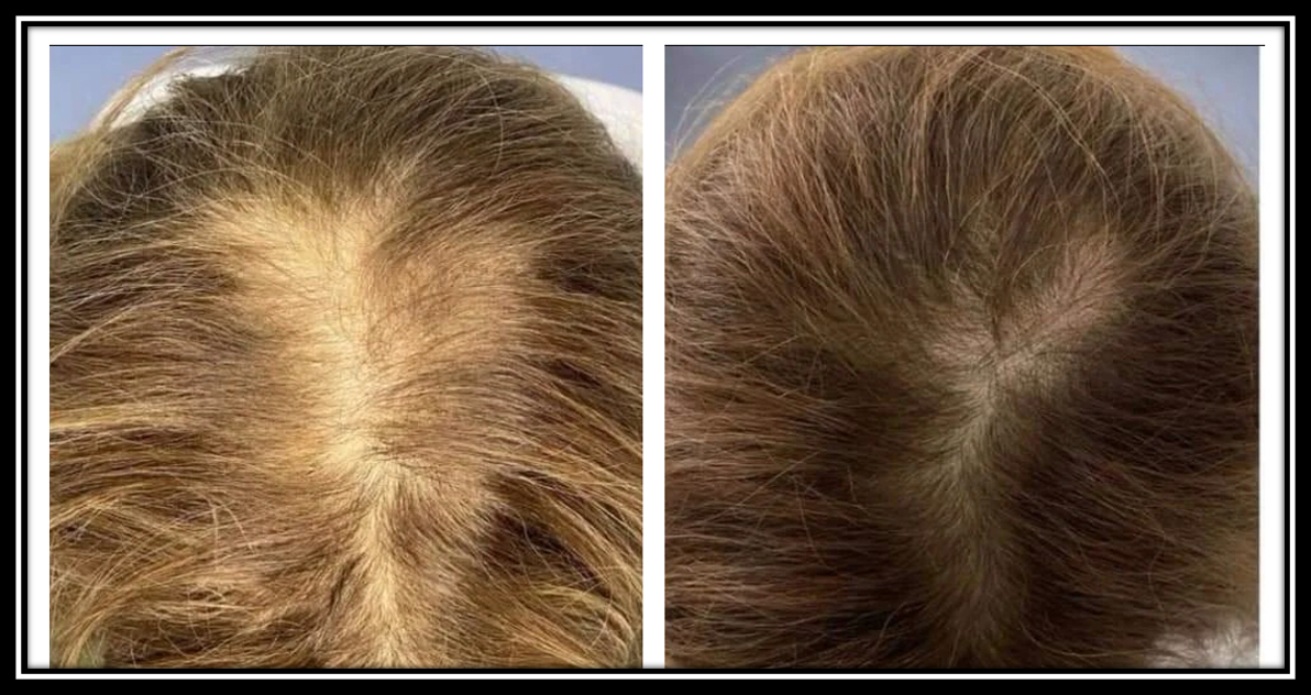 Age Zero™️ Exosomes Before After Photo - Scalp Treatment - Thicker Hair