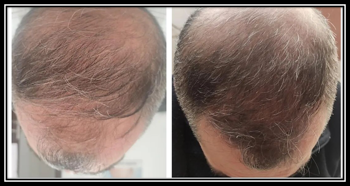 Age Zero™️ Exosomes Before After Photo - Scalp Treatment - Thicker Hair