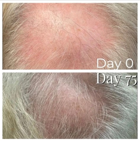 Age Zero™️ Exosomes Before After Photo - Scalp Treatment - Regrown Hair