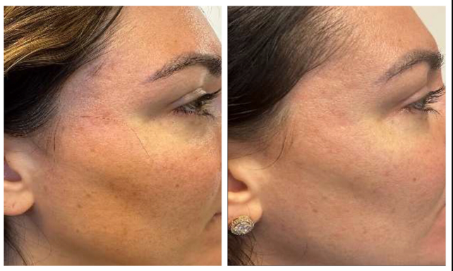 Age Zero™️ Exosomes Before After Photo Improved Skin Radiance