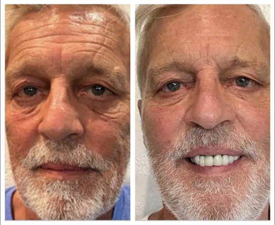 Age Zero™️ Exosomes Before After Photo Improved Skin Firmness