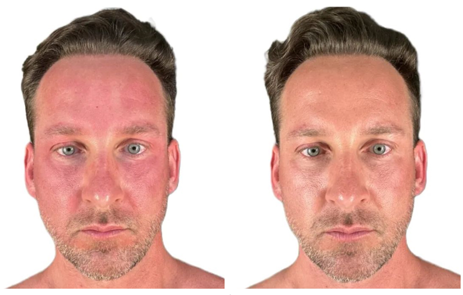 Age Zero™️ Exosomes Before After Photo