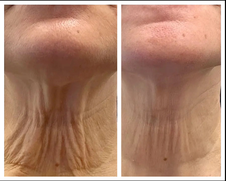 Age Zero™️ Exosomes Before After Photo - Scar Removal