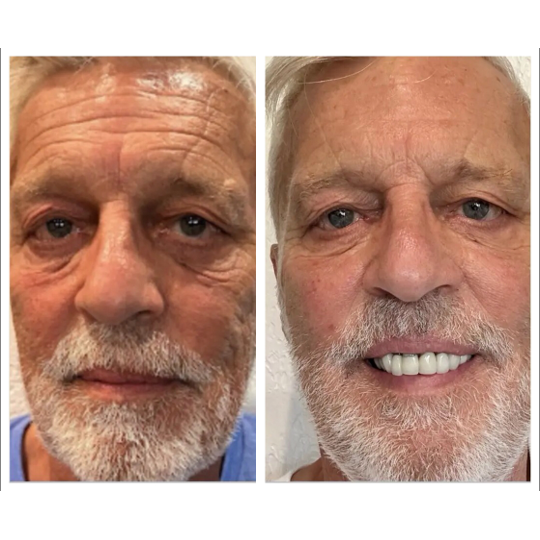 Age Zero™️ Exosomes Before After Photo Improved Skin Firmness